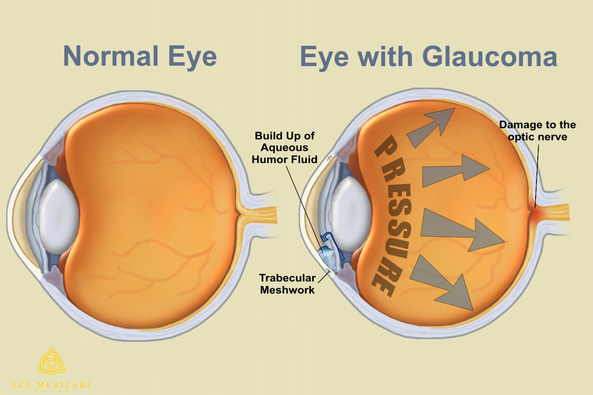 The Role of Exercise and Physical Activity in Managing Glaucoma
